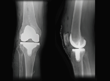 Total Knee Replacement Surgery Houston | Catherine Cahill MD