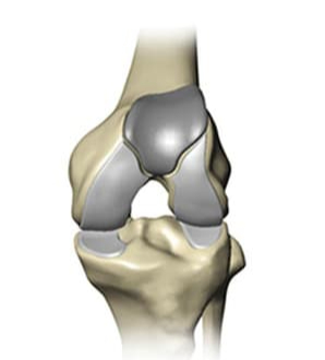 Partial Knee Replacement Surgeons Bellaire | Catherine Cahill MD