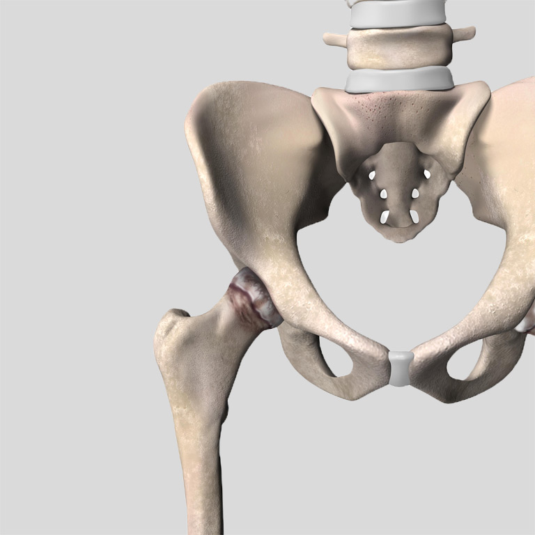 Hip Specialist in Northwest Houston, TX with Catherine Cahill MD.