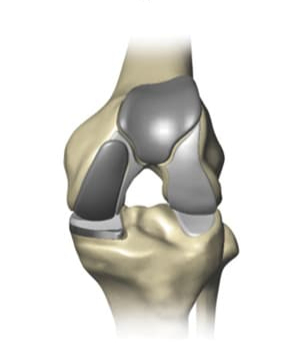 Knee Doctor in Northwest Houston, TX with Catherine Cahill MD.