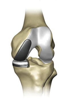 Knee Doctors Near Me in Northwest Houston, TX with Catherine Cahill MD.
