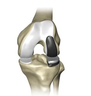 Knee Surgeon in Northwest Houston, TX with Catherine Cahill MD.